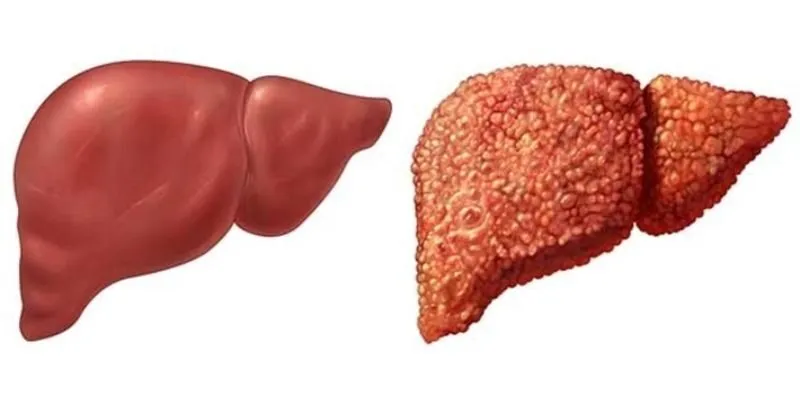 Hội nghị gan mật: Cập nhật và hướng đi mới trong điều trị bệnh lý gan mật